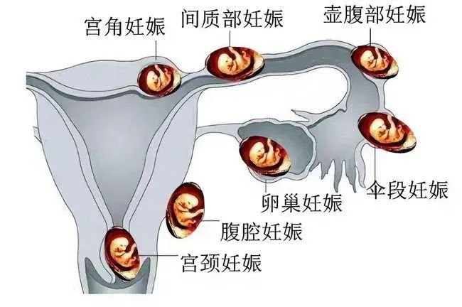 在马来西亚可以选择试管婴儿的性别只是家长需要满足以下条件