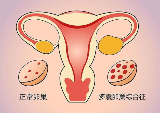 第三代试管婴儿常见的5种促排卵方案介绍